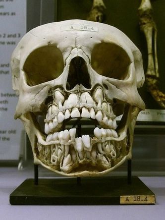 Cabeza de gigante con doble hilera de dientes