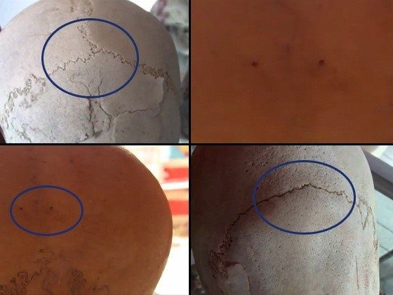 Comparación con un cráneo humano normal